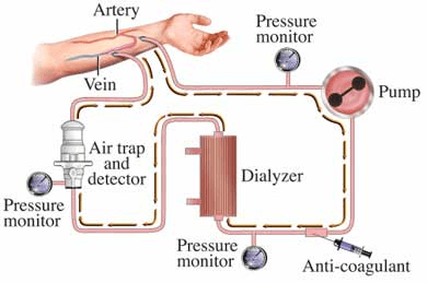 kidney transplant prognosis