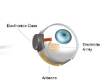 Implant May Treat All Forms of Blindness