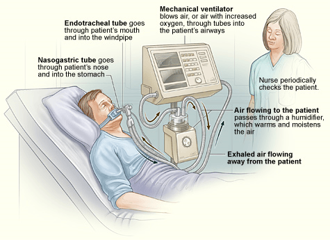 Medical Ventilators Selection Guide | Engineering360
