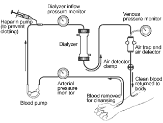 Hemodialysis process