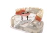 High Performance Polymers in Dental applications-Image