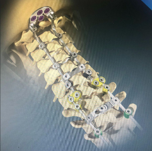 MIM for load-bearing orthopedic implants from Advanced Powder Products ...
