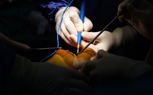 Coblation surgical assemblies-Image