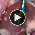 Implanted sensor signals transplant rejection