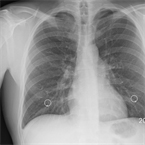 AI model estimates a subject’s true age according to their chest X-ray.