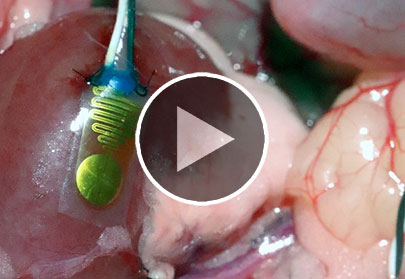 Implanted sensor signals transplant rejection.