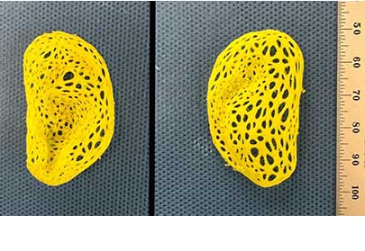 Team replicates an adult human ear using tissue engineering, 3D printing.
