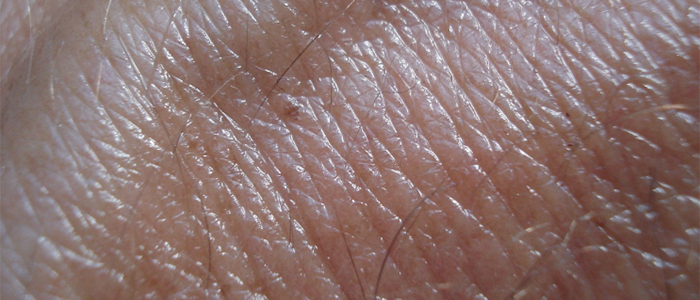 A new way to uncover skin cancer before it becomes visible