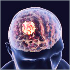 Transforming Neurovascular Microcatheter Production