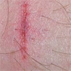Smart wound zipper conforms to irregular skin injuries, boosts healing in rats